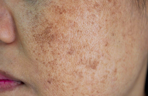 Skin Pigmentation Tips