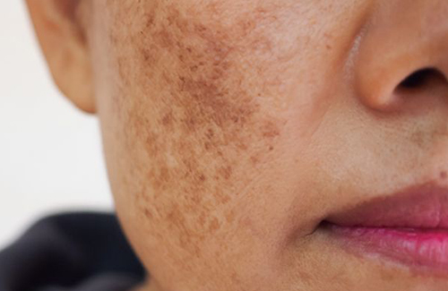 Pigmentation Home Remedies