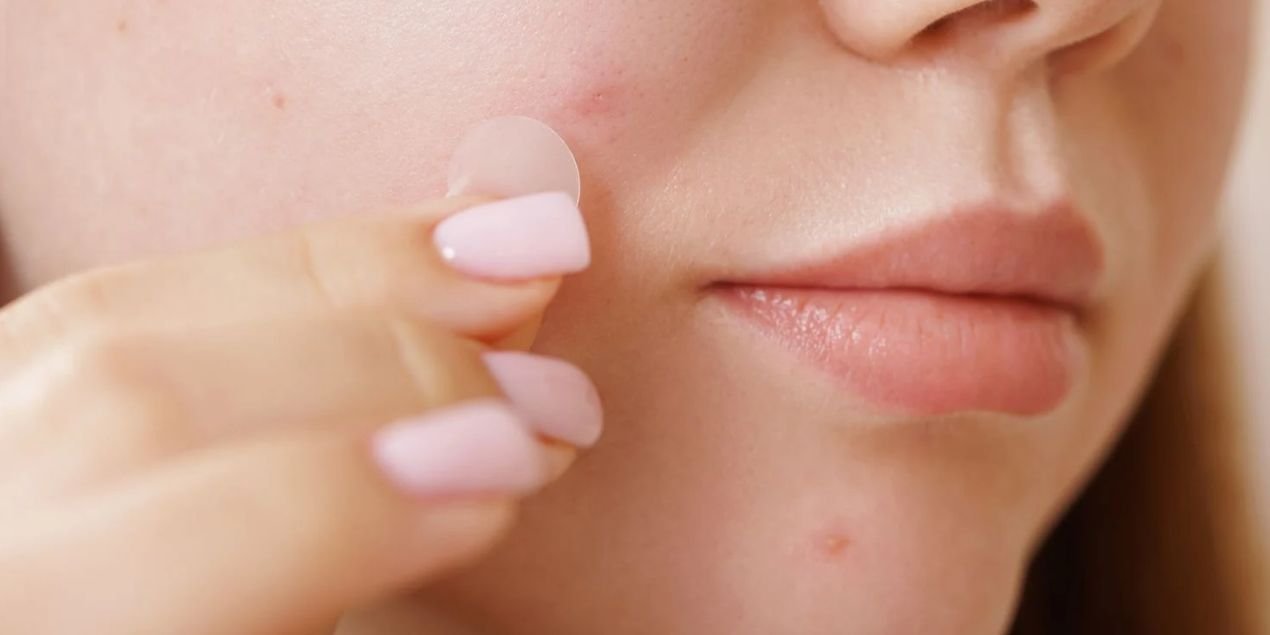 Do Pimple Patches Really Work? A Dermatologist's Honest Answer - The Skin Sensé Blog