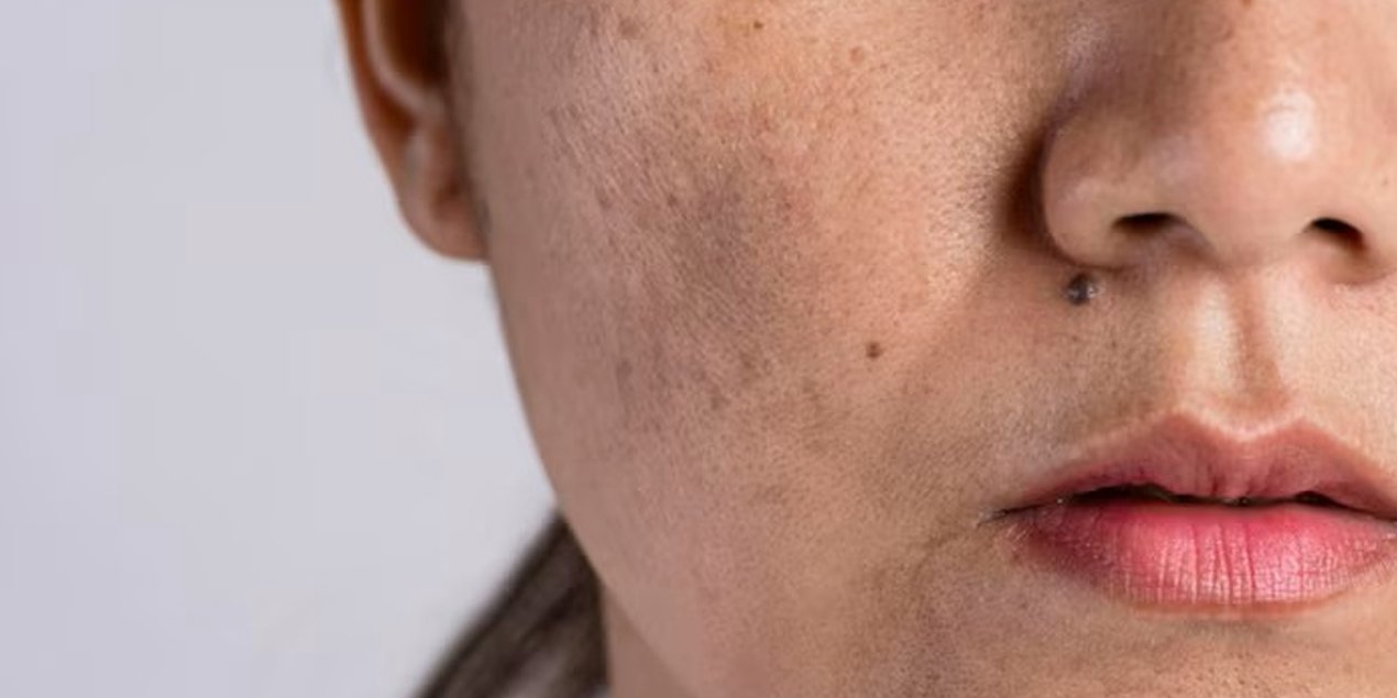 Best Pigmentation Treatment in Hyderabad: 6 Proven Ways to Treat Melasma & Dark Spots - The Skin Sensé Blog